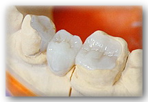 Mosty FRC uzupełnienie braku jednego zęba